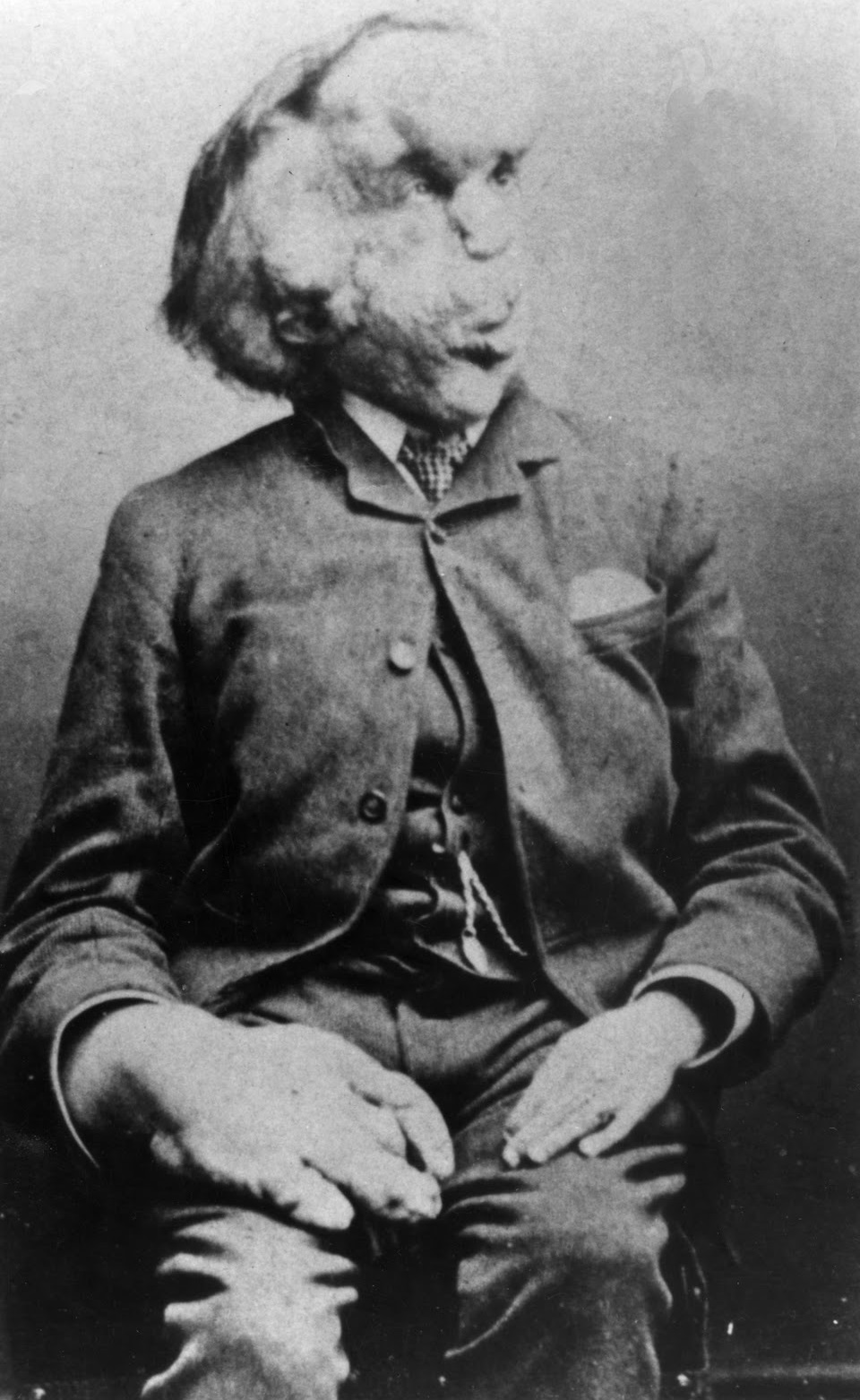 Joseph Merrick Foto